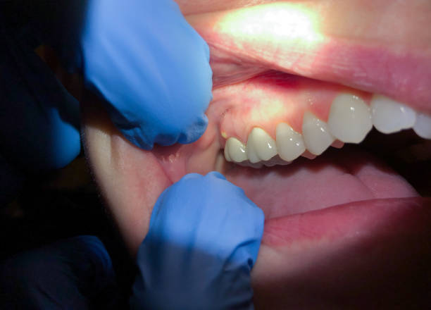 Best Emergency Tooth Extraction in Green, OR